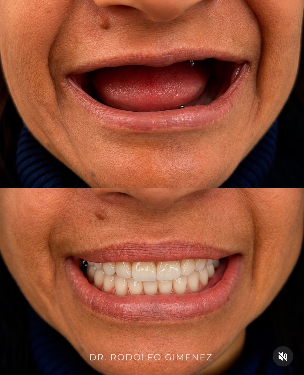Antes e depois de carga imediata: paciente sem dentes e, no mesmo dia, com o protocolo instalado