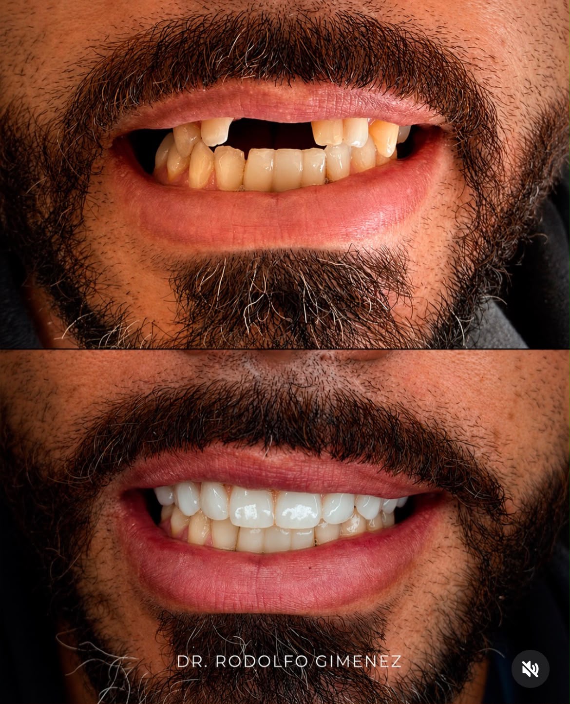 Caso 5: antes e depois de protocolo superior